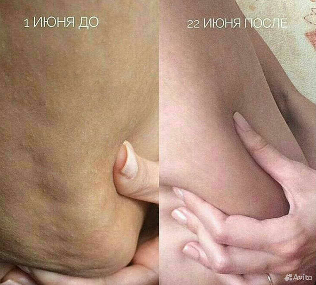 Антицеллюлитный крем до и после