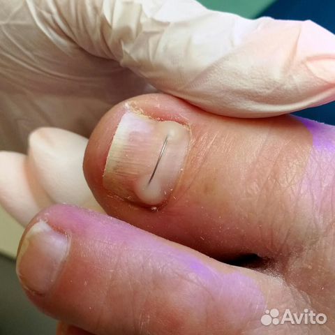 Вросший ноготь Онихолизис Титановая нить Подолог