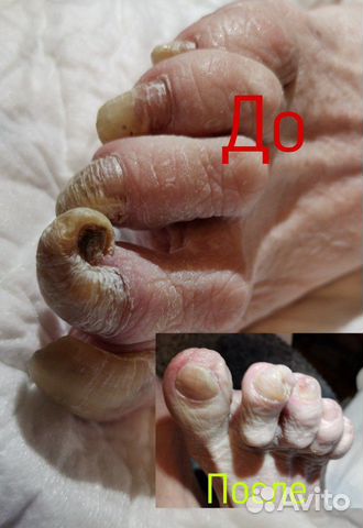 Медицинский педикюр.Выезд на дом.Любой р-он