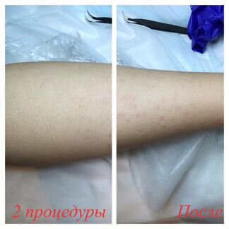 Электроэпиляция в Москве метро Серпуховская эпиляц